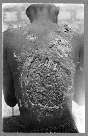The back of a Namibian laborer covered in scar tissue from years of whipping by a German Farmer named Ludwig Cramer, 1912/13. Taken by the Rhenish Missionary Johann Jakob Irle. [200 × 200]