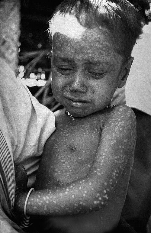 2-year-old Rahima Banu, the last variola major natural case in the world. Kuralia, Bangladesh. October 1975 [389×600]