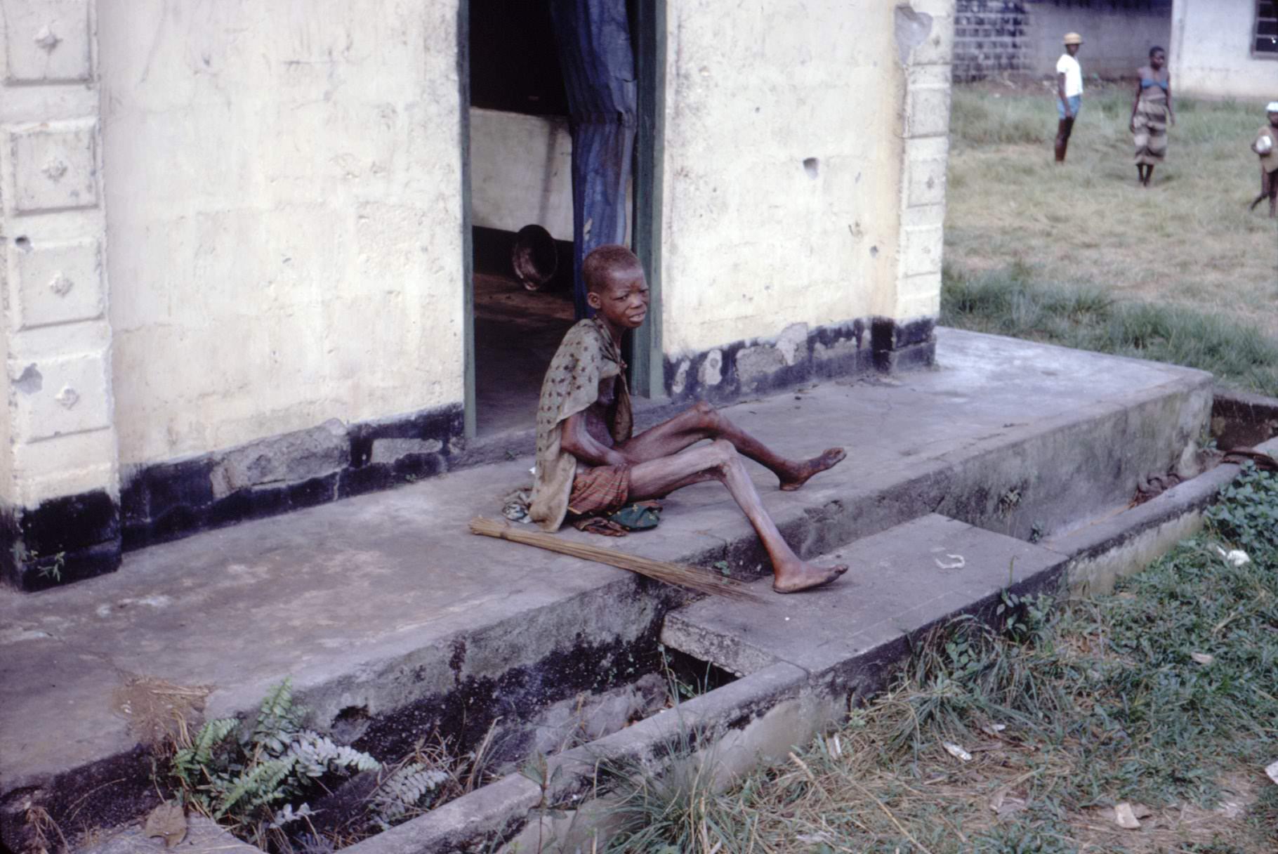 Severely malnourished Nigerian refugee being cared for in a refugee camp near the Nigerian-Biafran war zone. (Late 1960s) [1820 × 1216]