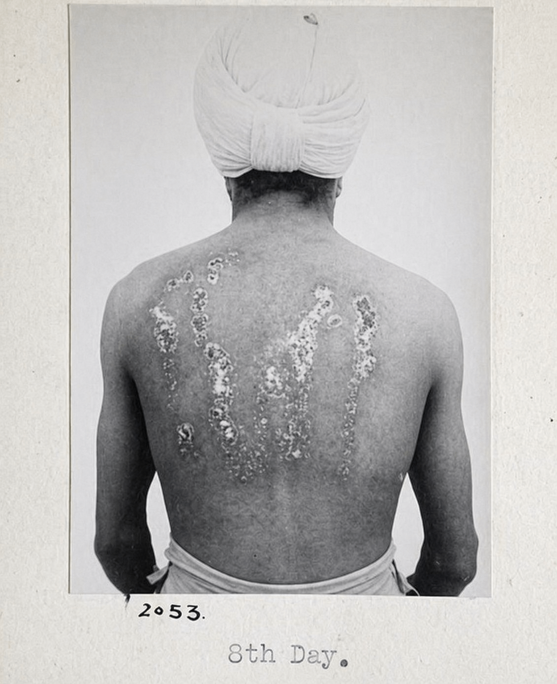 Rawalpindi Mustard Gas Experiments, British Indian Army Test Subject, Rawalpindi, British India, c. 1930s–1940s [476 X 584]