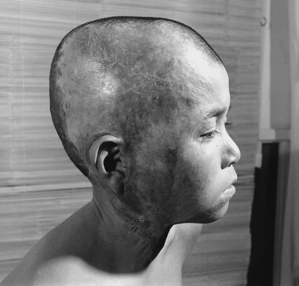 Survivor of the atomic bomb of Hiroshima, Japan, 4 years after, 1949. [1047×1000]