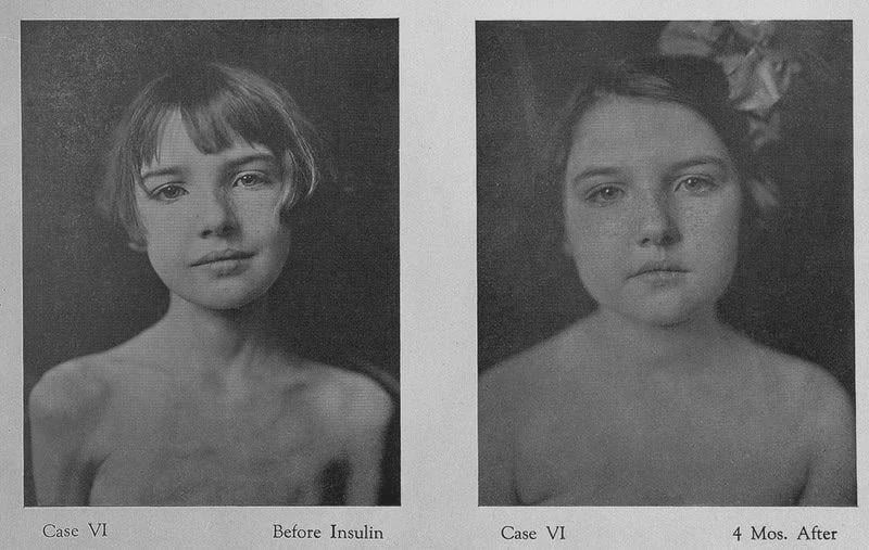 This photo was taken in 1922 of a little girl who was suffering from type 1 diabetes before insulin was available, she was waiting for the end of her life until a new experimental treatment called “Insulin” was used on her which reversed the severe weight loss and saved the girl. [800×507]