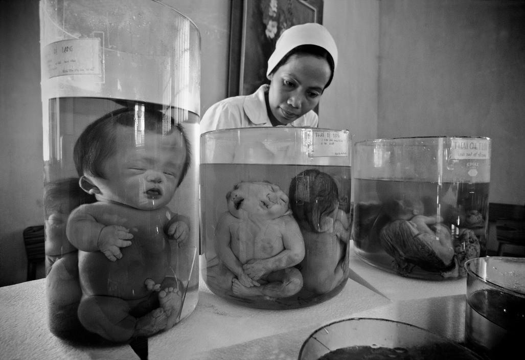 Deformed foetuses at Tû Dû Obstetrics Hospital in Vietnam. Specimens frequently associated with the lasting health consequences of Agent Orange, a herbicide used during the Vietnam War. (1998) [4,682 x 3,114]
